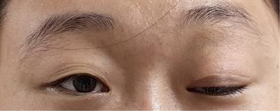 A case of IgG4-related ophthalmic disease after SARS-CoV-2 vaccination: case report and literature review